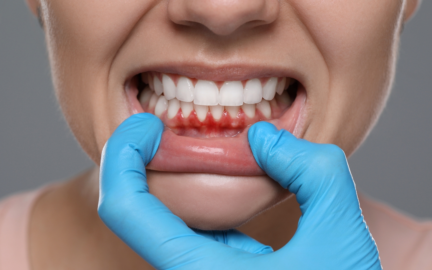 Gum Treatment